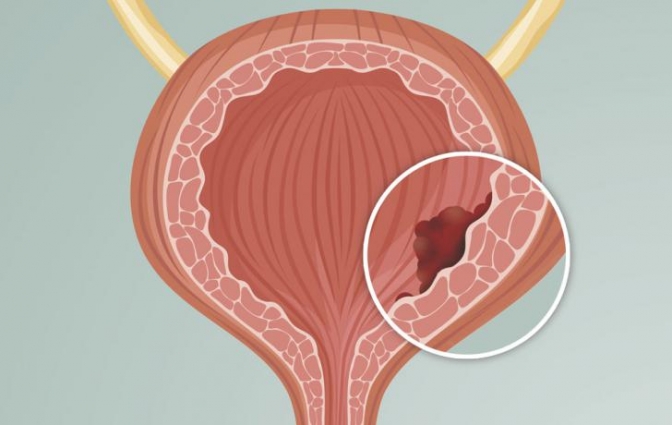 Oncólogos afirman que un nuevo tratamiento para el cáncer de vejiga supera la sobrevida de dos años