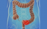 Estudio confirma la relación entre el consumo de carne roja y el cáncer colorrectal