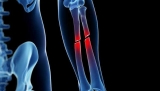 Ante fracturas óseas hay que descartar la presencia de osteoporosis